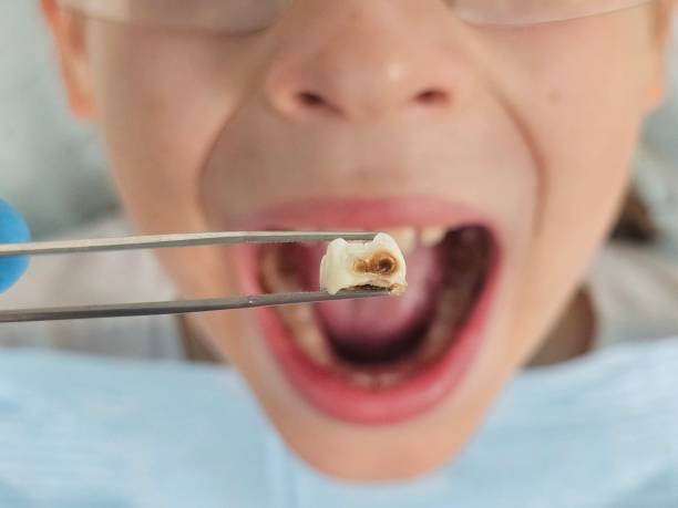 Best Emergency Wisdom Teeth Removal in Valley Forge, TN